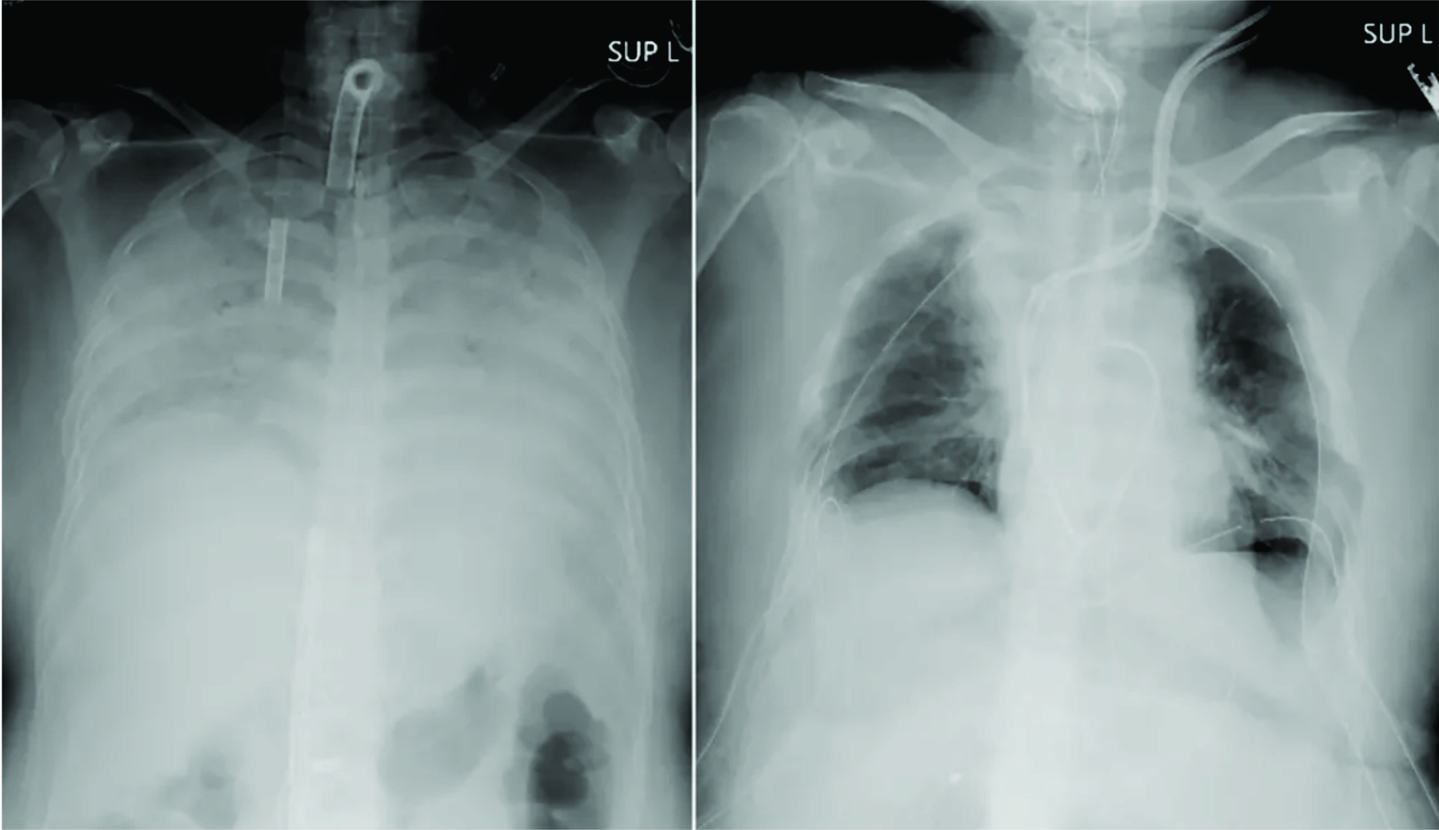 Japoneses anunciam o 1º transplante mundial de tecido pulmonar de doadores vivos para um paciente com grave lesão pulmonar causada pela Covid-19. Radiografias fornecidas em 9 de abril de 2021 pelo Hospital Universitário de Quioto mostram o tórax de um